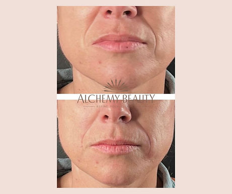 Two close-up images of a person's lower face, showing skincare or cosmetic treatment results. The text "Alchemy Beauty" is visible across the top.