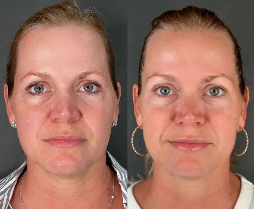 Two side-by-side close-up images of a person showing facial features before and after. Dark background, no landmarks or historical buildings.