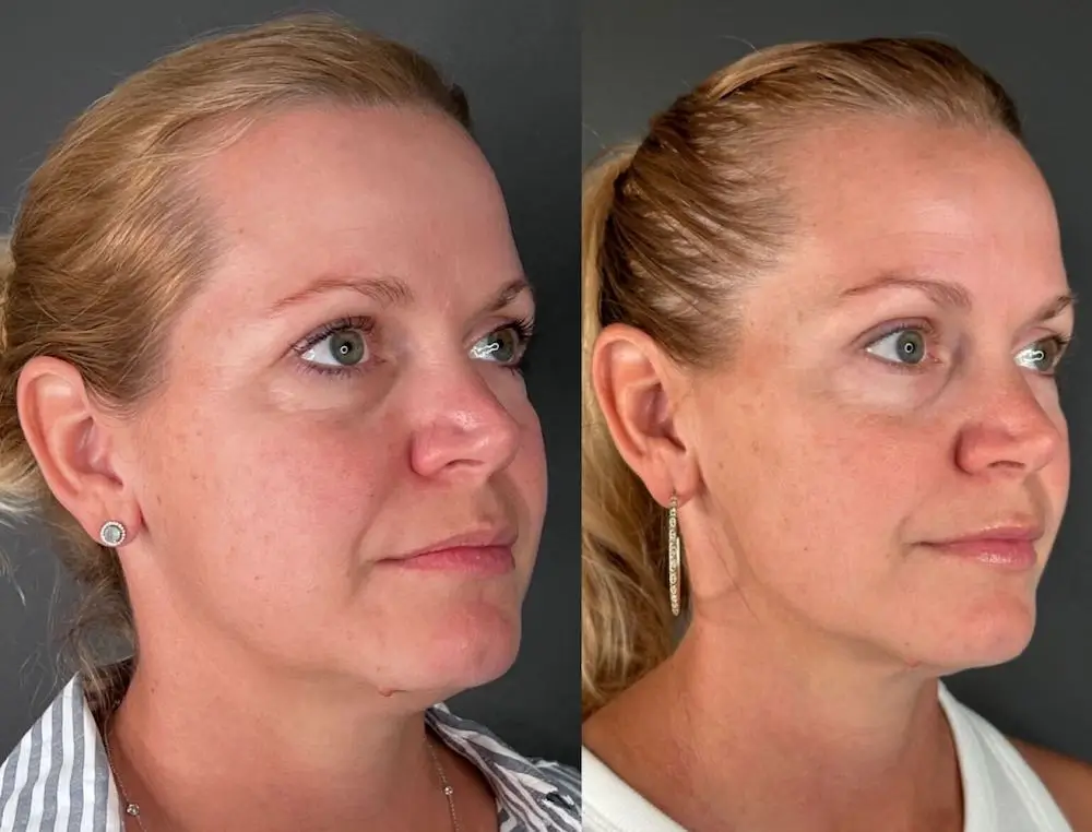 Two side-by-side photos of a person before and after a cosmetic change, highlighting differences in appearance, hair, and earrings.