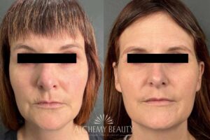 Two side-by-side images show a person's face, before and after aesthetic treatment. The images include black bars over eyes for anonymity.