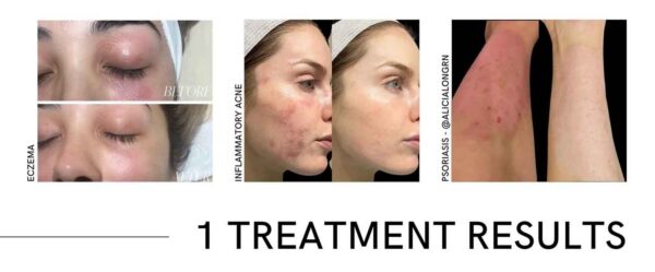 CO2Lift® Pro Topical Carboxy Gel Treatment - Image 4