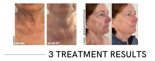 CO2Lift® Pro Topical Carboxy Gel Treatment - Image 3