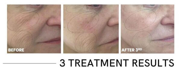 CO2Lift® Pro Topical Carboxy Gel Treatment - Image 2